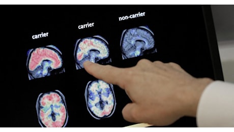 Alzheimer, scoperto un meccanismo cellulare chiave della malattia. Lo studio degli scienziati Usa