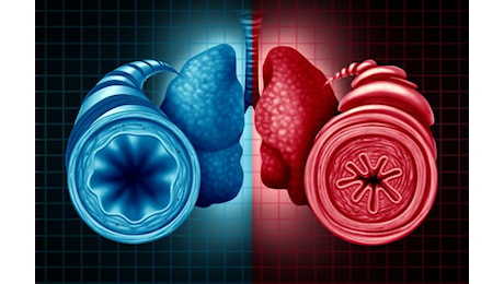 Una Nuova Svolta nella Cura dell’Asma: Il Ruolo del Benralizumab