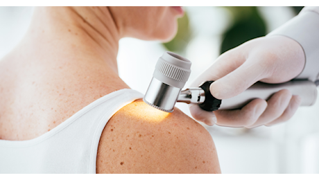 Melanoma, 2024 anno ‘nero’: +30% di diagnosi. Cresce l’immunoterapia