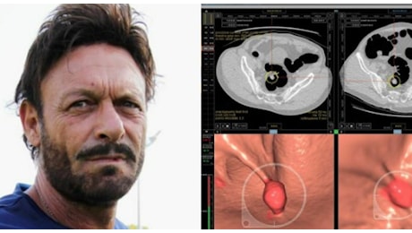 Totò Schillaci e il tumore al colon: cause, sintomi e cura. «Pazienti sempre più giovani»